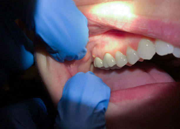 Best Cracked Tooth Emergency Dentist  in Olney, MD