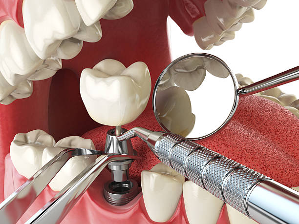 Best Chipped Tooth Repair Near Me  in Olney, MD